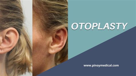 belo otoplasty price